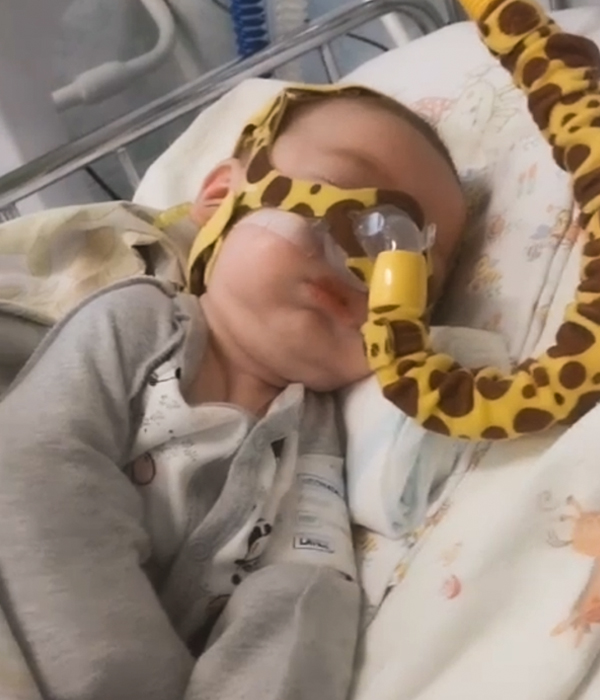 Spinal muscular atrophy image 2